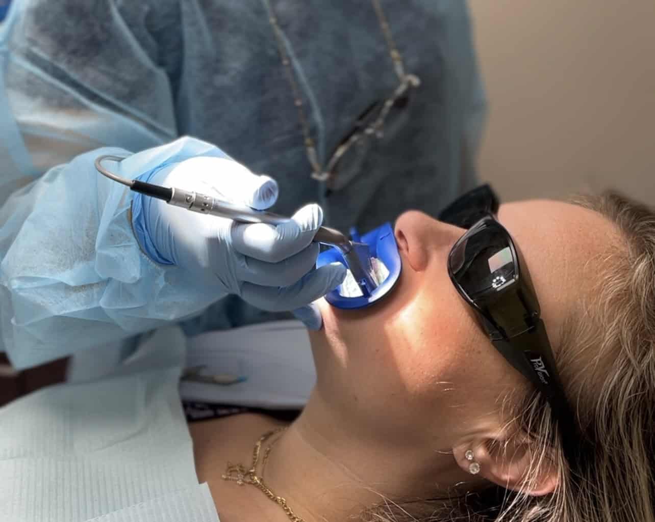 Laser Teeth Whitening at Expert Dental